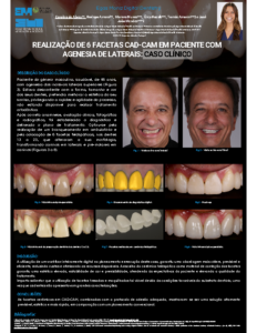 Realização de 6 facetas CAD-CAM em paciente com agenesia de laterais – Caso clínico