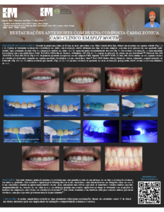 Restaurações Anteriores com Resina Composta Camaleónica – Caso Clínico em Split Mouth